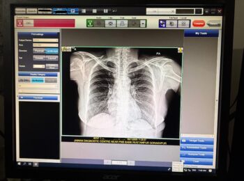 X-Ray Chest